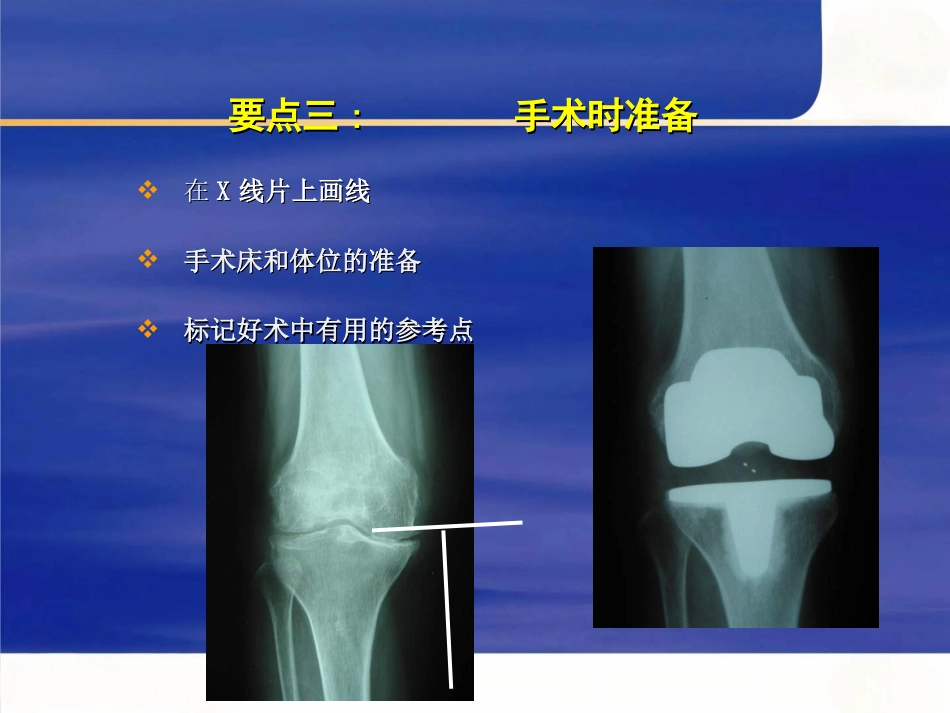 tka手术操作要点_第15页