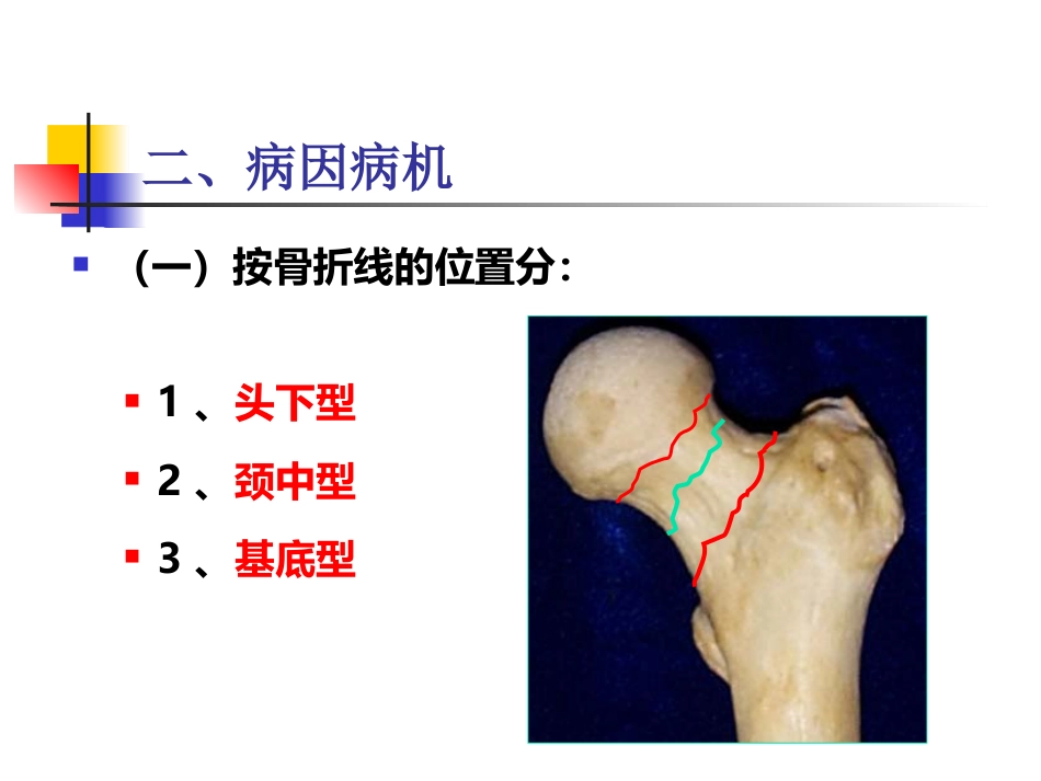 股骨颈骨折概述_第6页