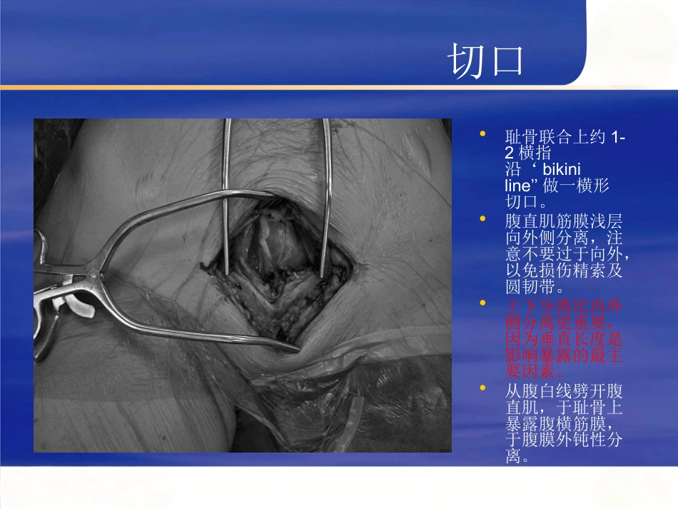 改良Stoppa入路在骨盆髋臼骨折中的应用_第13页