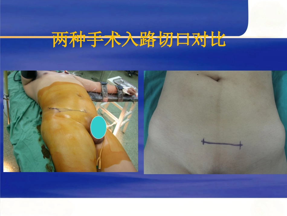改良Stoppa入路在骨盆髋臼骨折中的应用_第3页