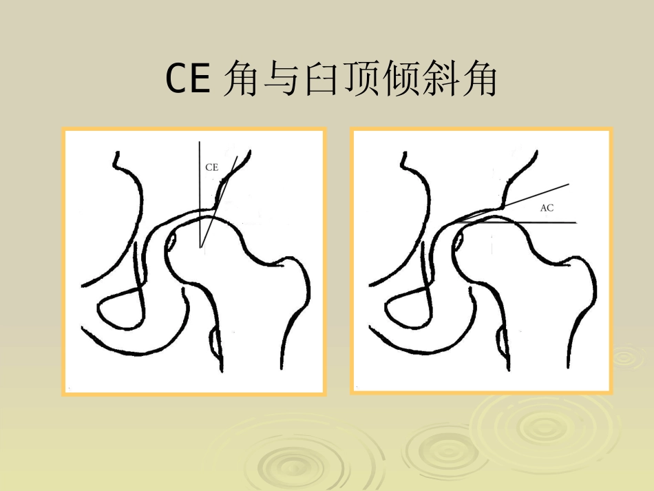 Ganz截骨术z_第13页