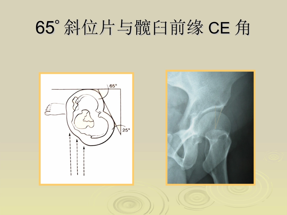 Ganz截骨术z_第15页
