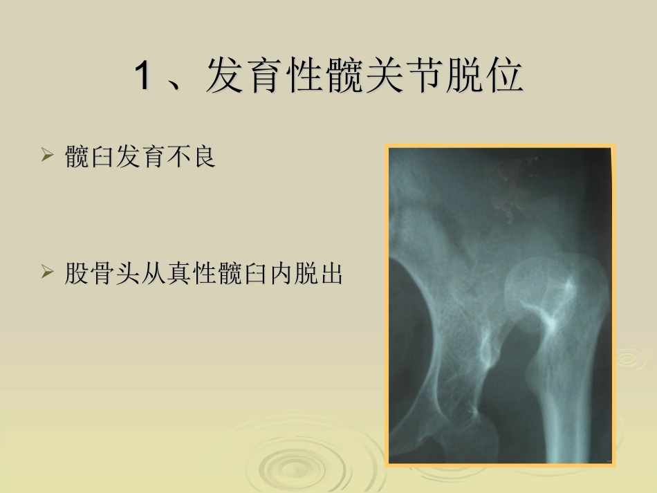 Ganz截骨术z_第2页
