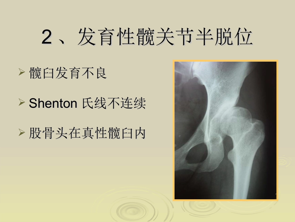 Ganz截骨术z_第3页