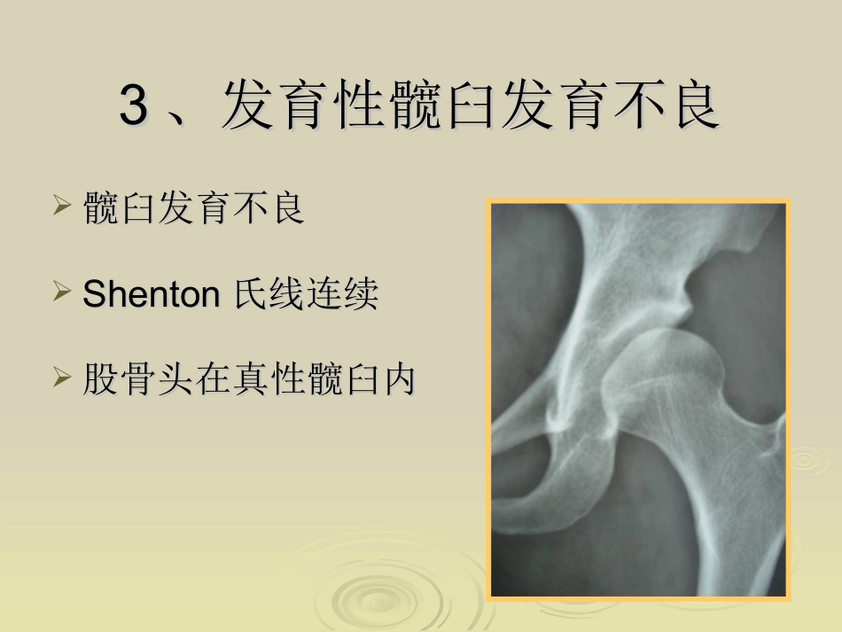 Ganz截骨术z_第4页