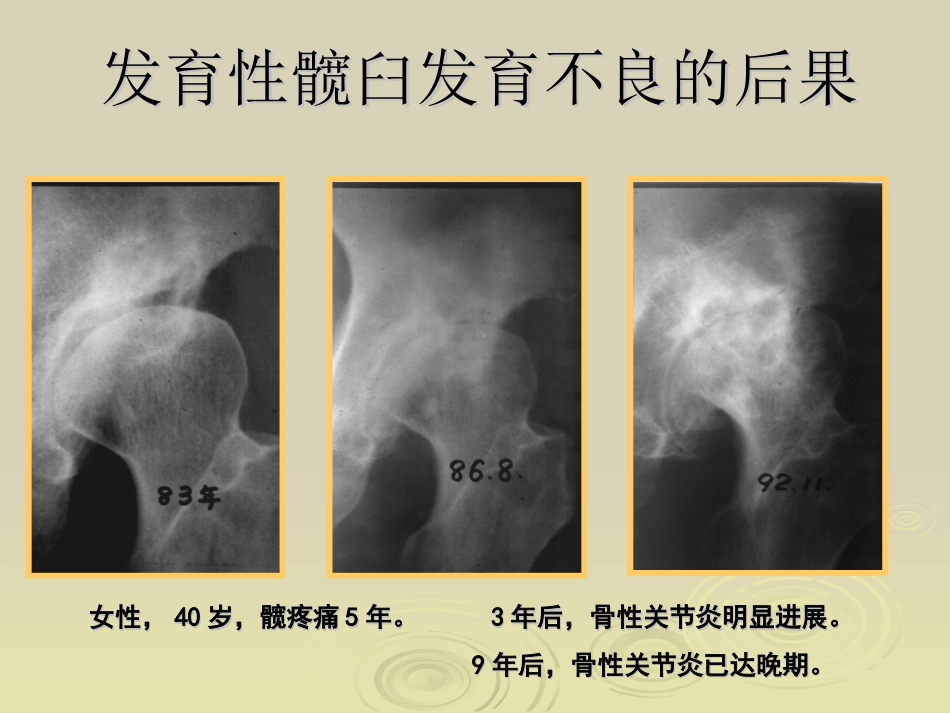 Ganz截骨术z_第6页