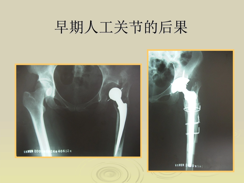 Ganz截骨术z_第7页