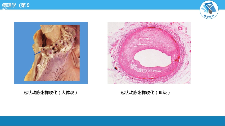 病理学-动脉粥样硬化PPT课件_第12页