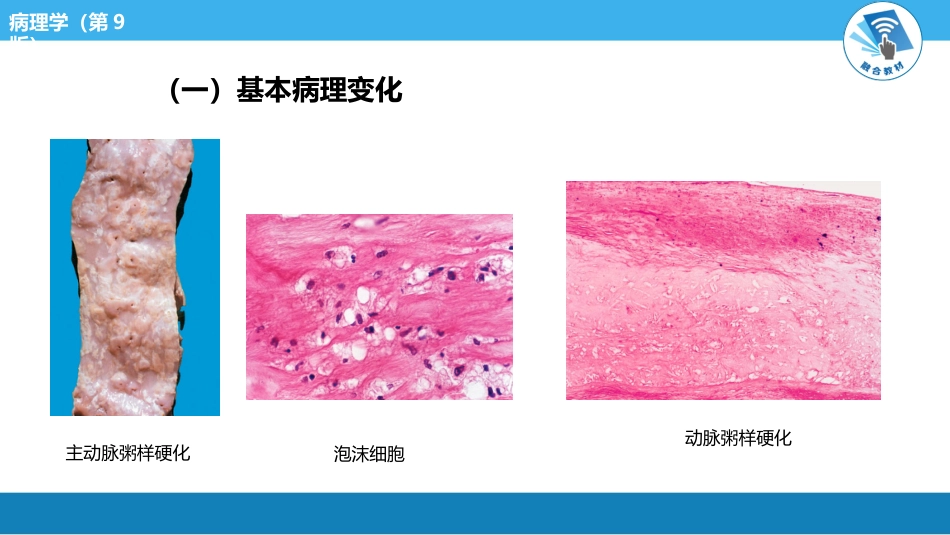 病理学-动脉粥样硬化PPT课件_第8页