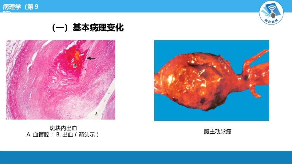 病理学-动脉粥样硬化PPT课件_第9页