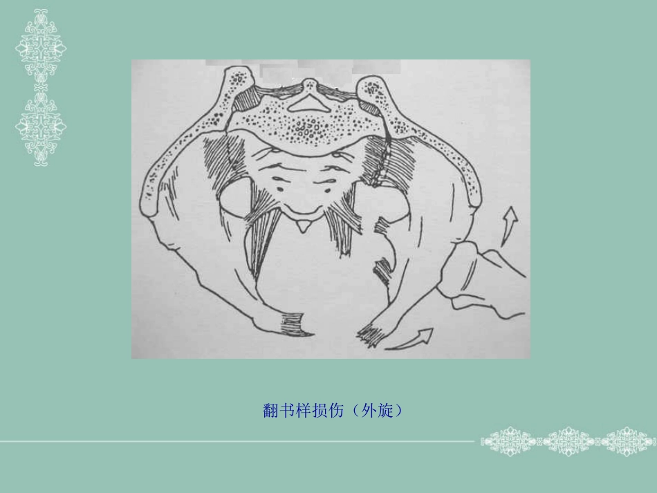 骨盆、髋臼骨折的分型_第6页
