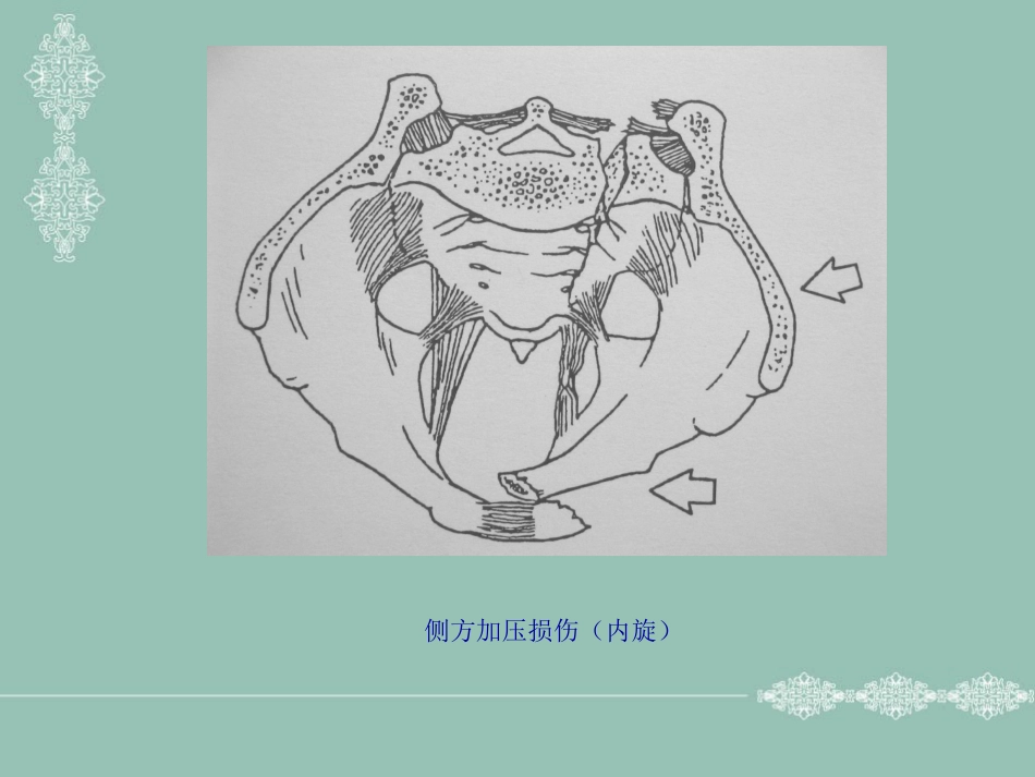 骨盆、髋臼骨折的分型_第7页