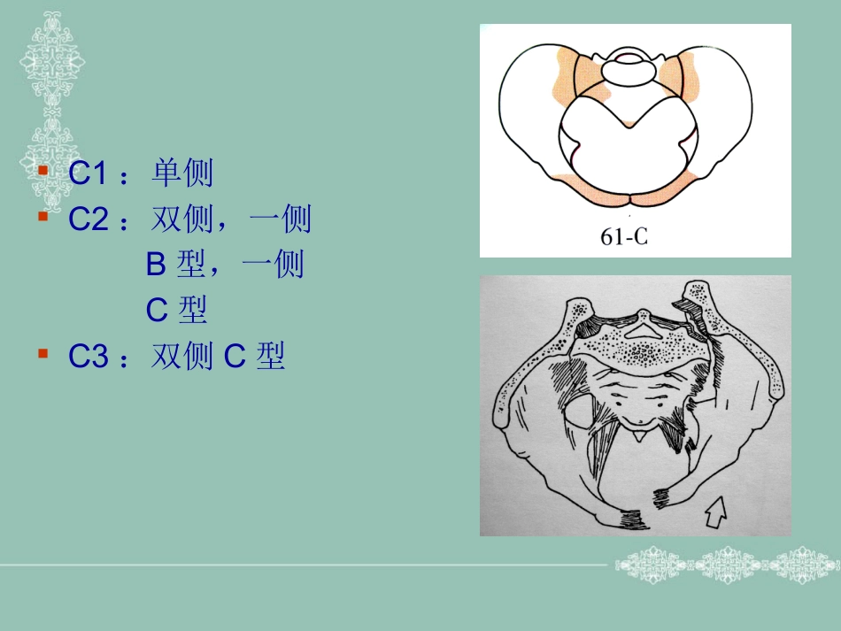 骨盆、髋臼骨折的分型_第8页