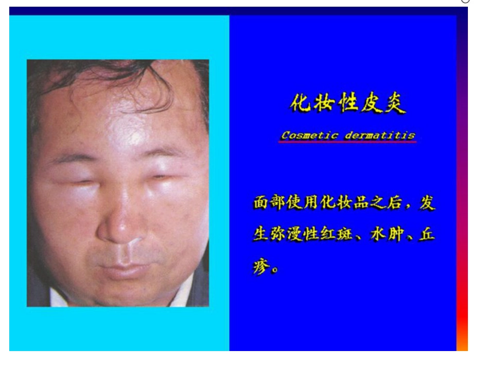 《病理学》水肿 ppt课件_第9页