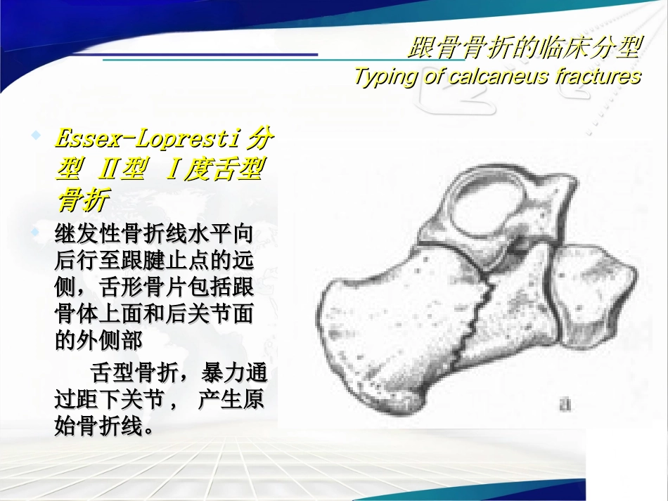 跟骨骨折的分型与治疗讲座_第12页