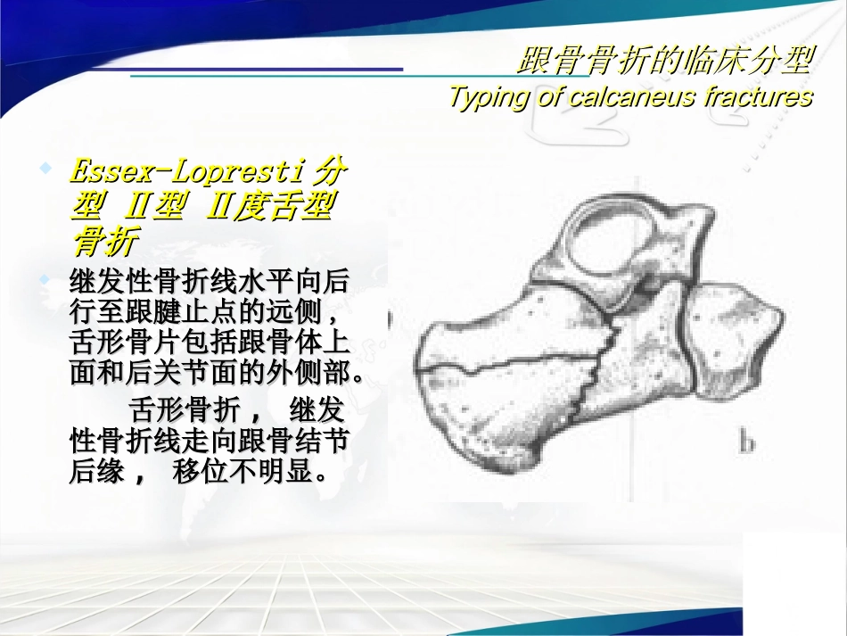 跟骨骨折的分型与治疗讲座_第13页