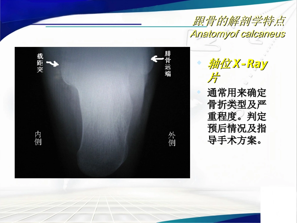 跟骨骨折的分型与治疗讲座_第4页