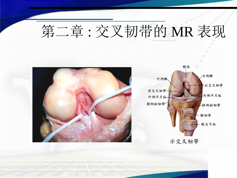 半月板损伤、交叉韧带及肩袖损伤的MR表现_第12页
