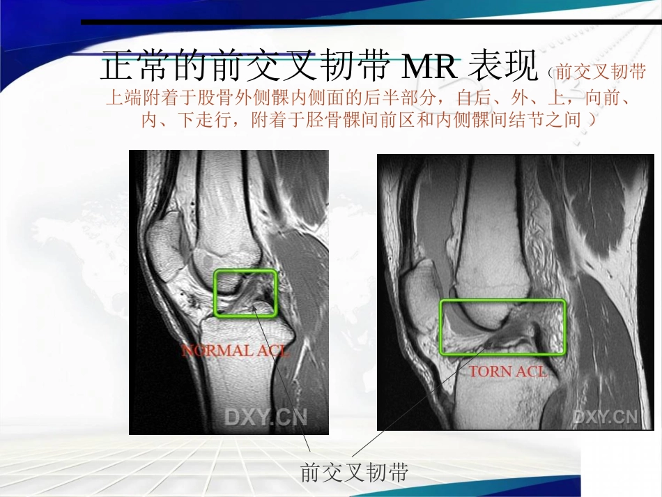 半月板损伤、交叉韧带及肩袖损伤的MR表现_第13页
