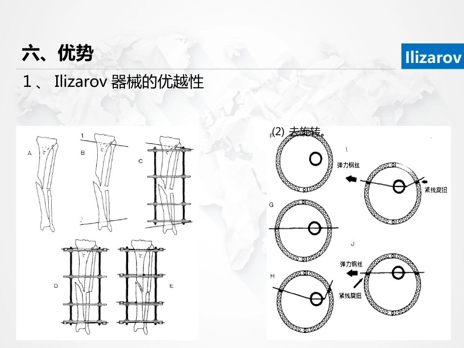 Ilizarov外固定架骨搬运术围手术期的护理_第12页