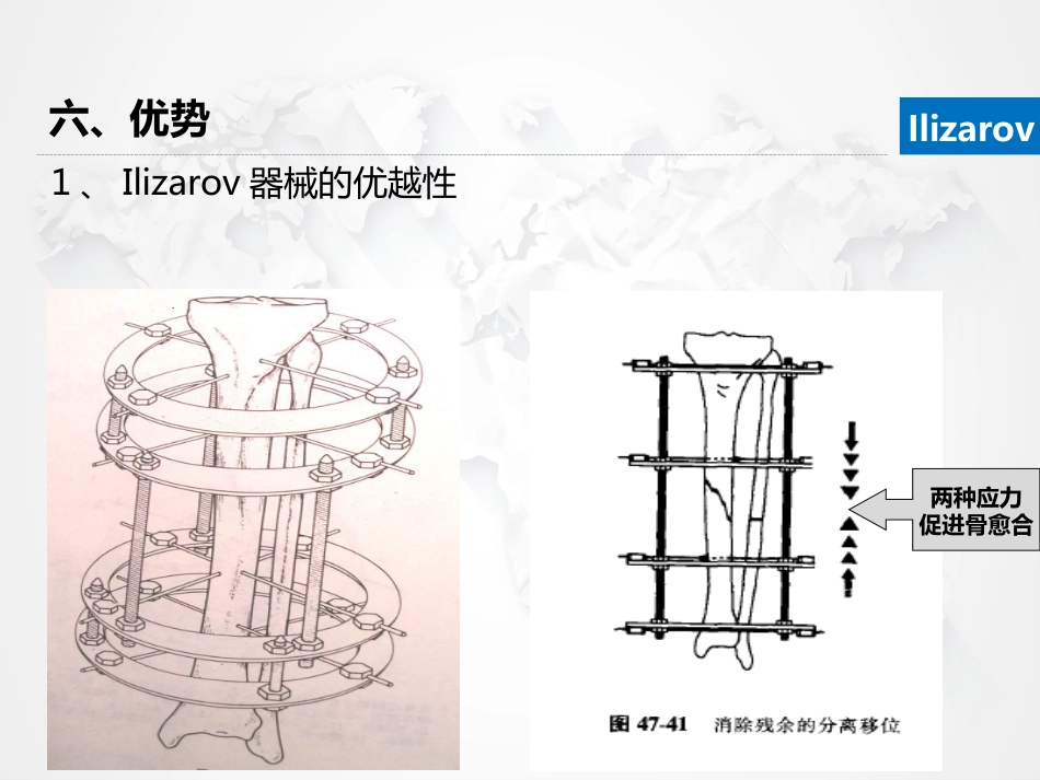 Ilizarov外固定架骨搬运术围手术期的护理_第13页