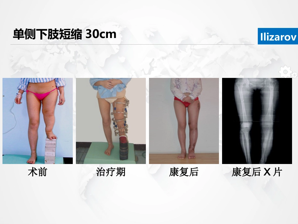 Ilizarov外固定架骨搬运术围手术期的护理_第5页