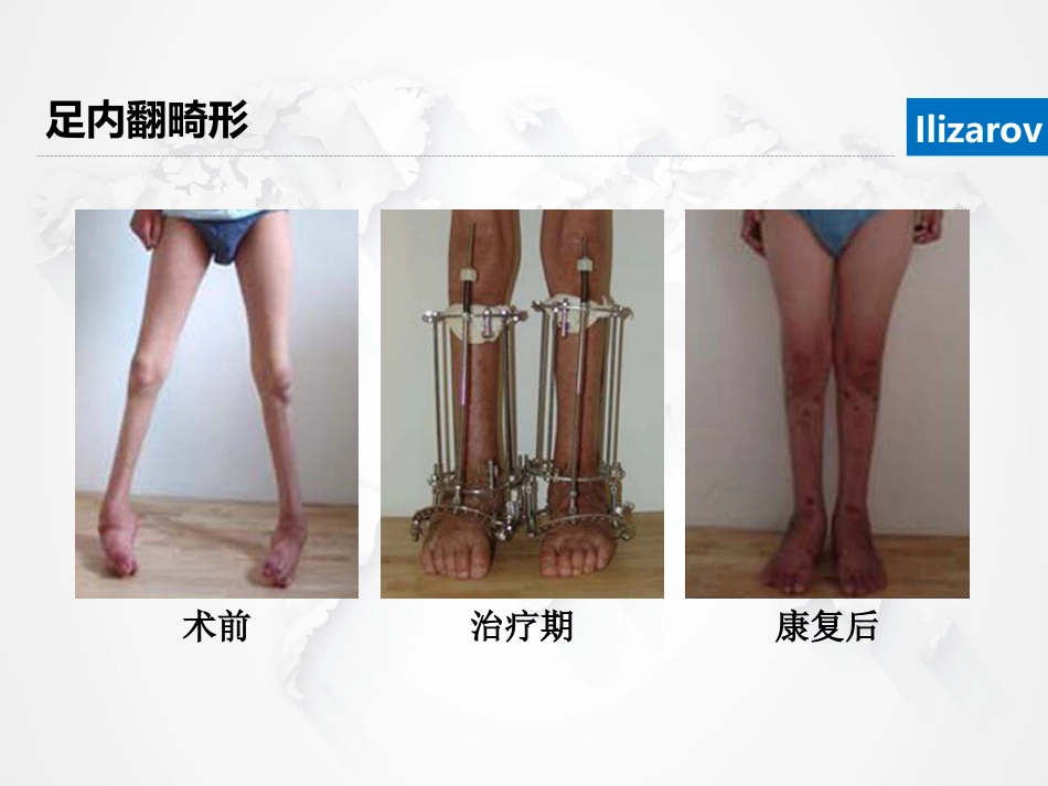 Ilizarov外固定架骨搬运术围手术期的护理_第6页