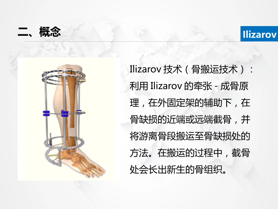 Ilizarov外固定架骨搬运术围手术期的护理_第8页