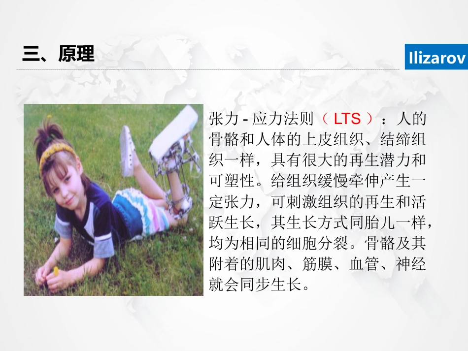 Ilizarov外固定架骨搬运术围手术期的护理_第9页