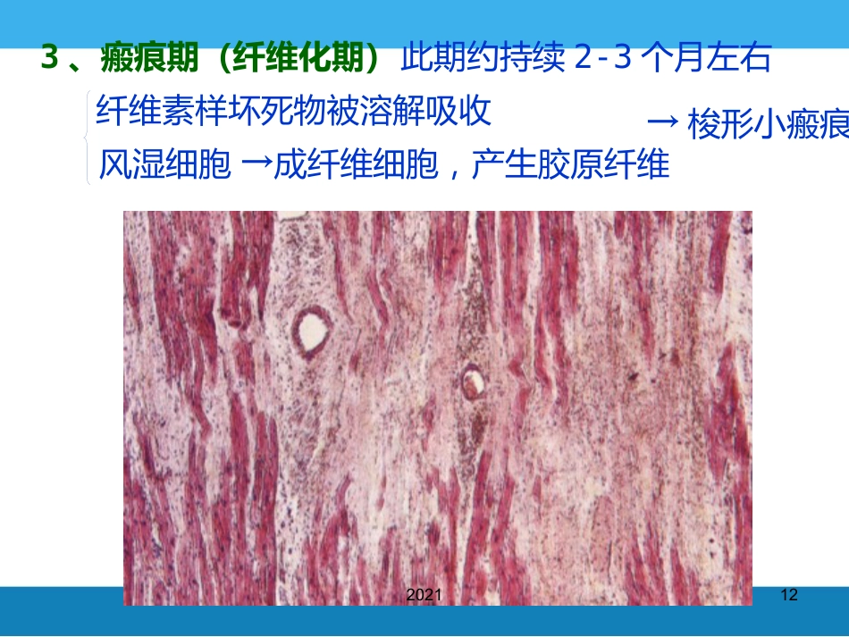 病理学-风湿病PPT课件_第12页
