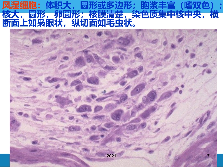 病理学-风湿病PPT课件_第7页
