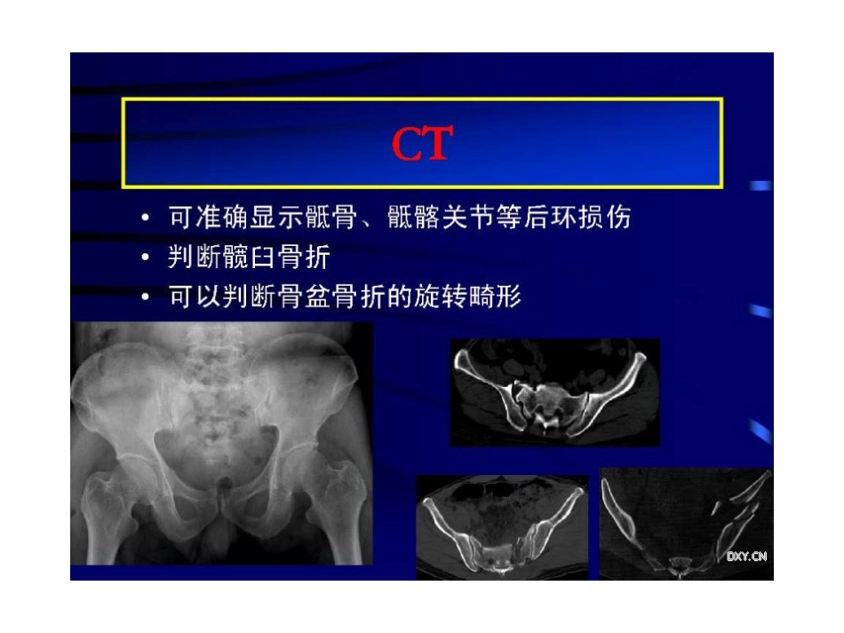 骨盆与髋臼骨折的诊断与分型_第10页