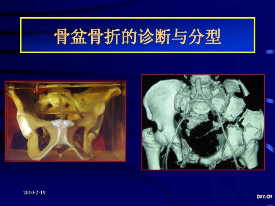 骨盆与髋臼骨折的诊断与分型_第2页