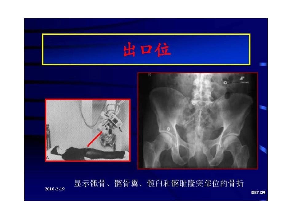 骨盆与髋臼骨折的诊断与分型_第9页