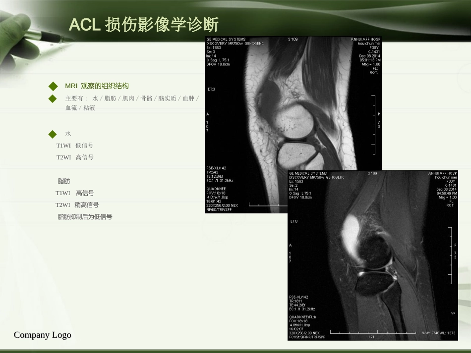 ACL损伤影像学诊断教程_第11页