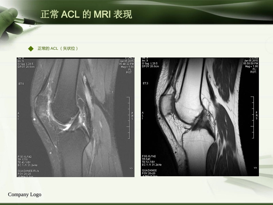 ACL损伤影像学诊断教程_第15页