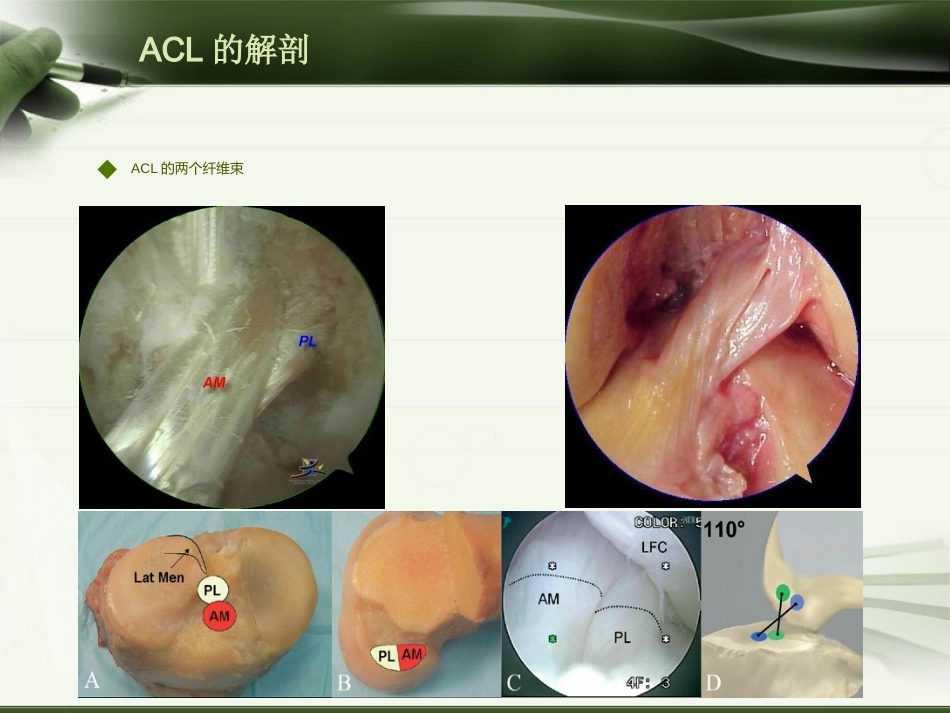ACL损伤影像学诊断教程_第2页