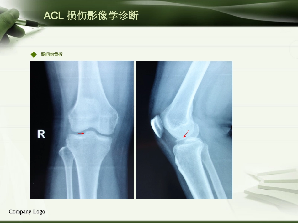 ACL损伤影像学诊断教程_第6页