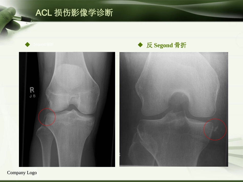 ACL损伤影像学诊断教程_第7页
