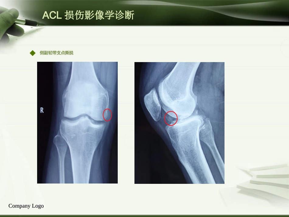 ACL损伤影像学诊断教程_第8页