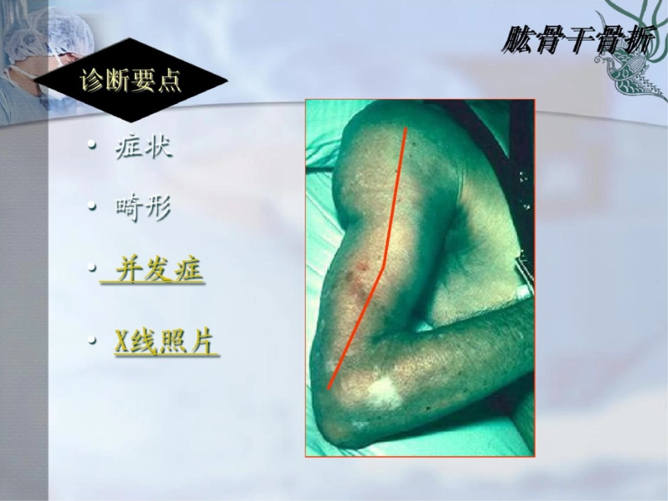 肱骨干骨折PPT课件_第10页