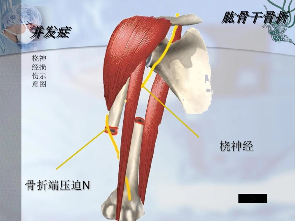 肱骨干骨折PPT课件_第11页
