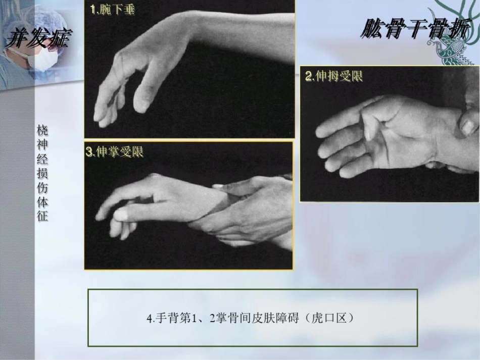 肱骨干骨折PPT课件_第12页