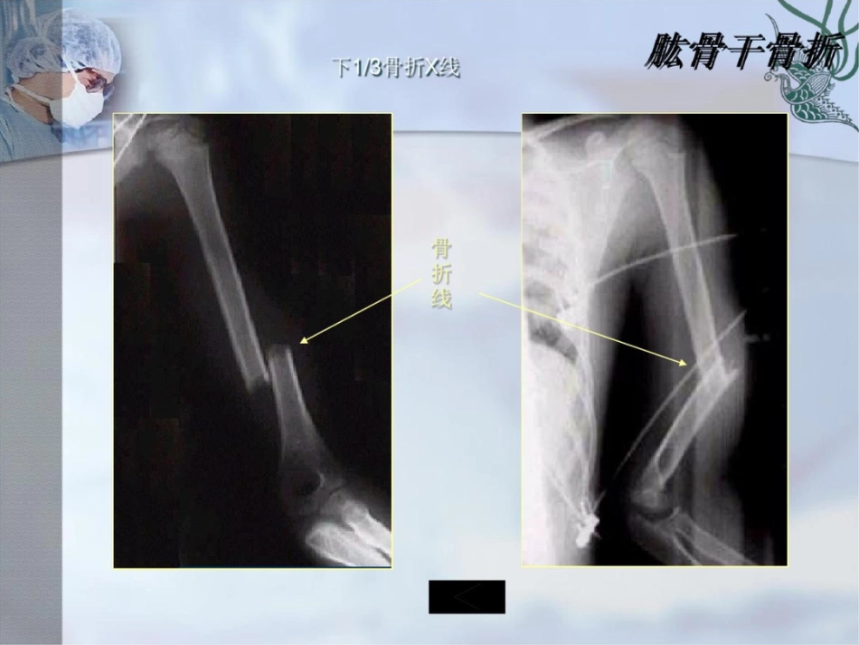 肱骨干骨折PPT课件_第14页