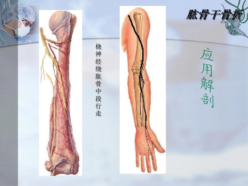 肱骨干骨折PPT课件_第4页