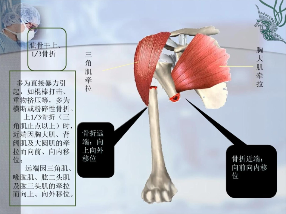 肱骨干骨折PPT课件_第5页