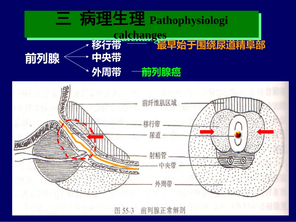 良性前列腺增生症_第6页