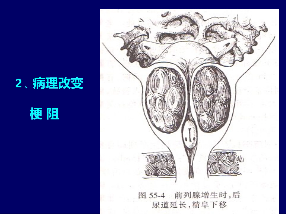 良性前列腺增生症_第7页