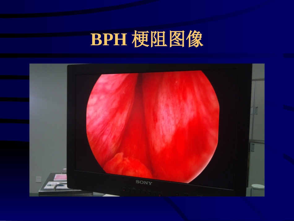 良性前列腺增生症_第8页