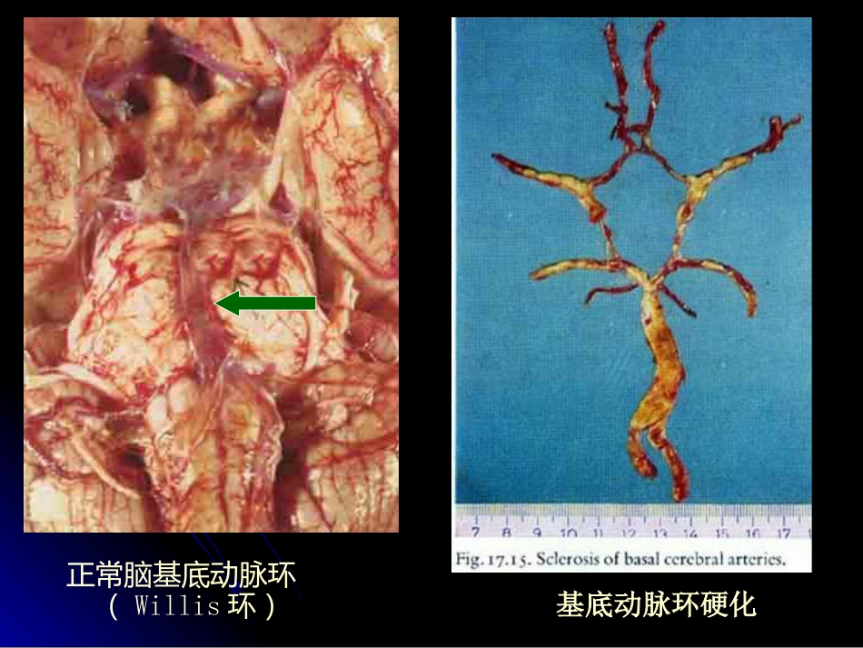 病理学动脉粥样硬化症中部分_第11页